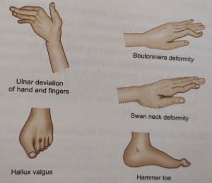 Rheumatoid Arthritis deformities in hand and foot